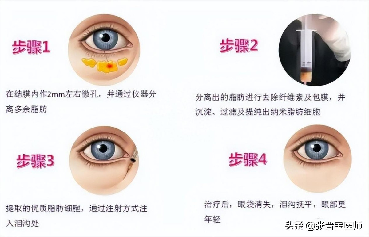 44岁女做眼袋切除适合吗,眼袋手术28岁