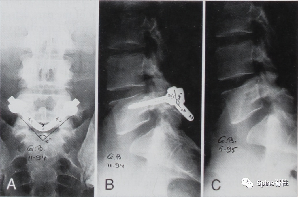 轻度峡部裂和重度峡部裂的区别,真性峡部裂和假性峡部裂