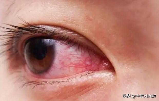 眼睛痒有血丝，说一个方子，养阴、活血还祛风，改善眼睛干涩红痒