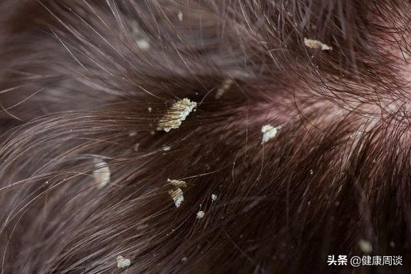 头皮痒有小疙瘩中医,头皮发痒头屑多医生建议