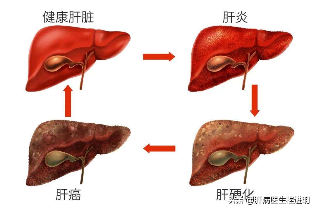 乙肝大三阳患者的寿命有多长,乙肝早期肝硬化的平均寿命多长