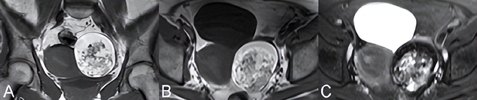 卵巢病变需要做什么检查,卵巢巧克力囊肿磁共振表现