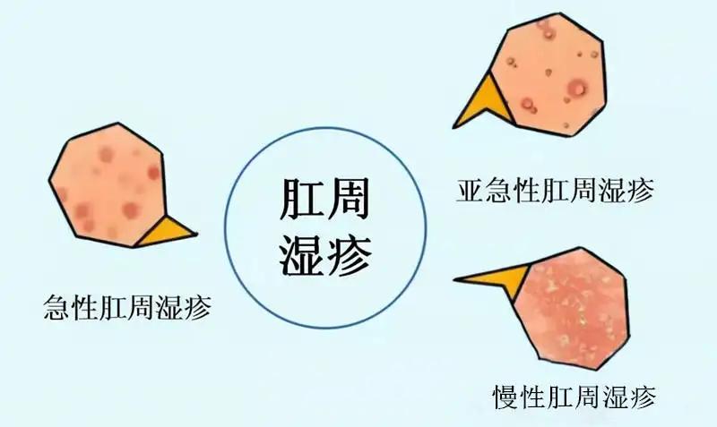 肛周皮肤湿疹是什么原因,肛周湿疹皮肤变粉红色