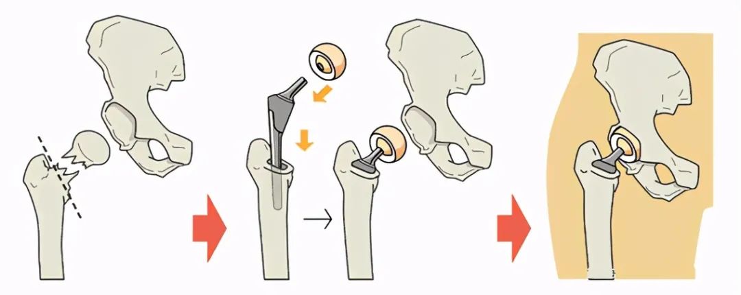 老年人摔折腿怎么康复,老人摔断腿手术需要注意什么