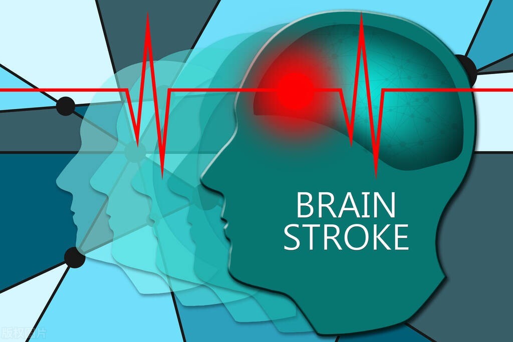 脑部血管堵塞引起的脑梗,得了脑梗有血管堵了能保守治疗吗