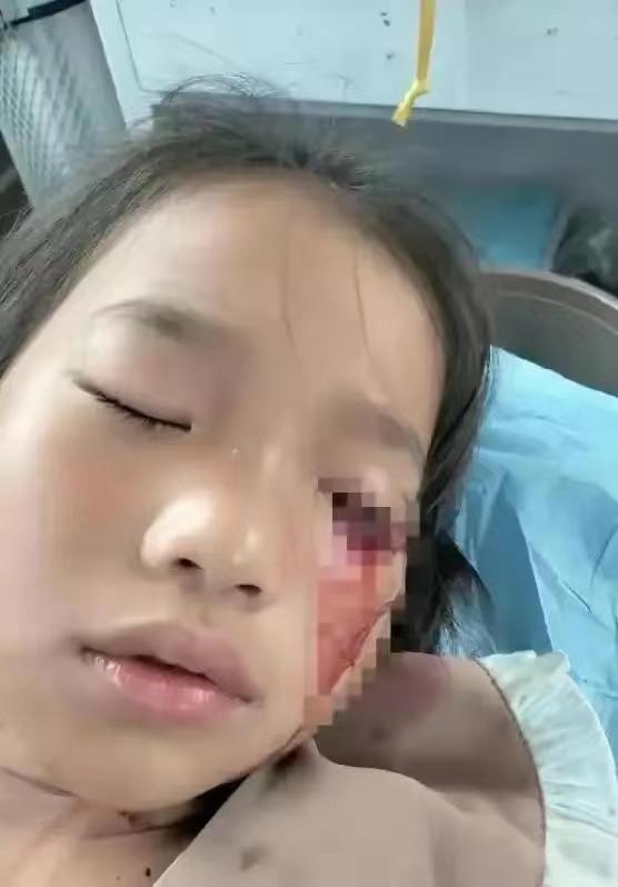 8岁女孩眼睛被打失明事件,8岁女孩被弹弓致左眼失明后续