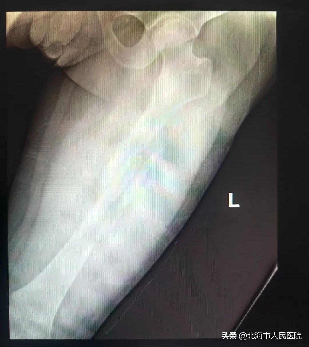 男子踢球撞到门柱成植物人,男子足球撞门柱