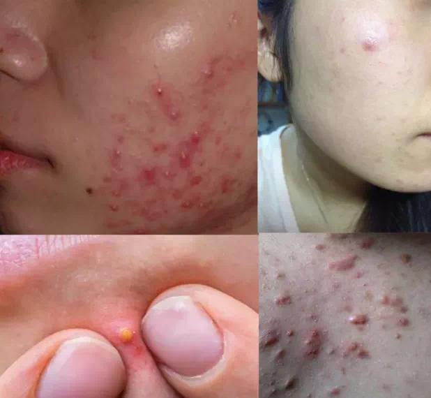 成年人崩溃的一瞬间就是反复长痘...