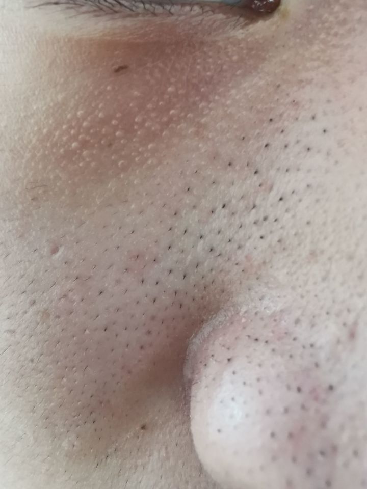 真黑头怎么去,黑头用黑头膏为什么去不掉黑头