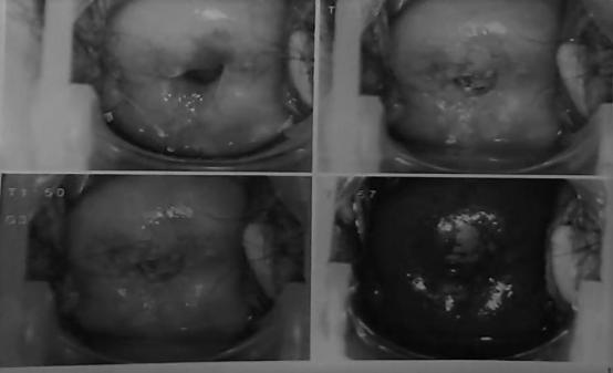让“隐形”的宫颈癌前病变“无处遁形”，阴道镜检查可确诊