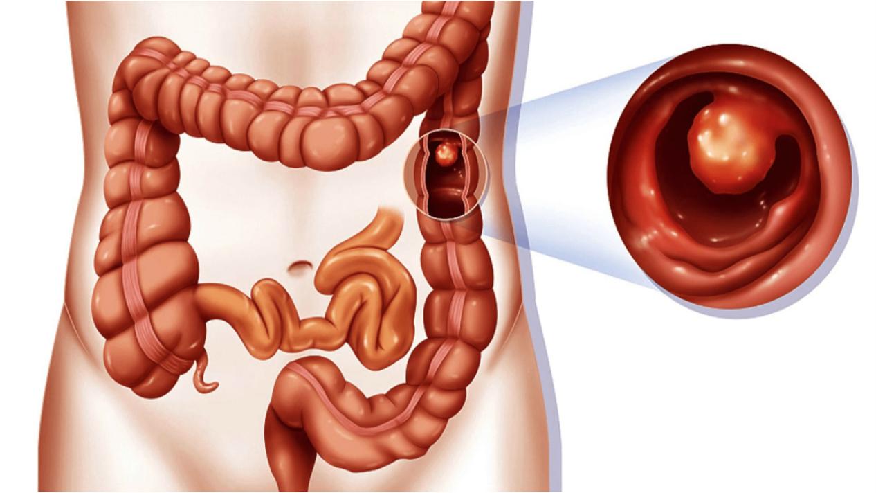 老年人腿摔骨折吃什么恢复快,老年人摔倒骨折的最佳治疗方法