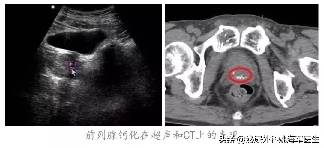 小谈前列腺炎你该知道的知识,了解治疗前列腺炎的误区有哪些
