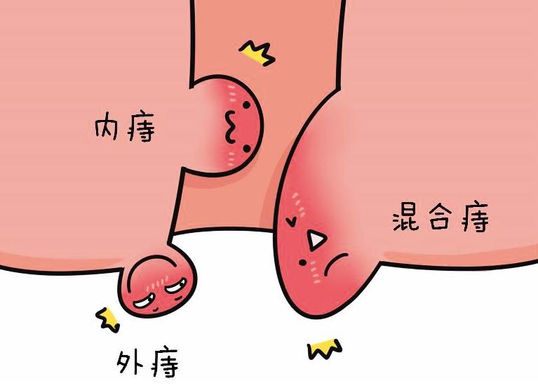 肛门附近的癌症症状,体内有癌大便先知