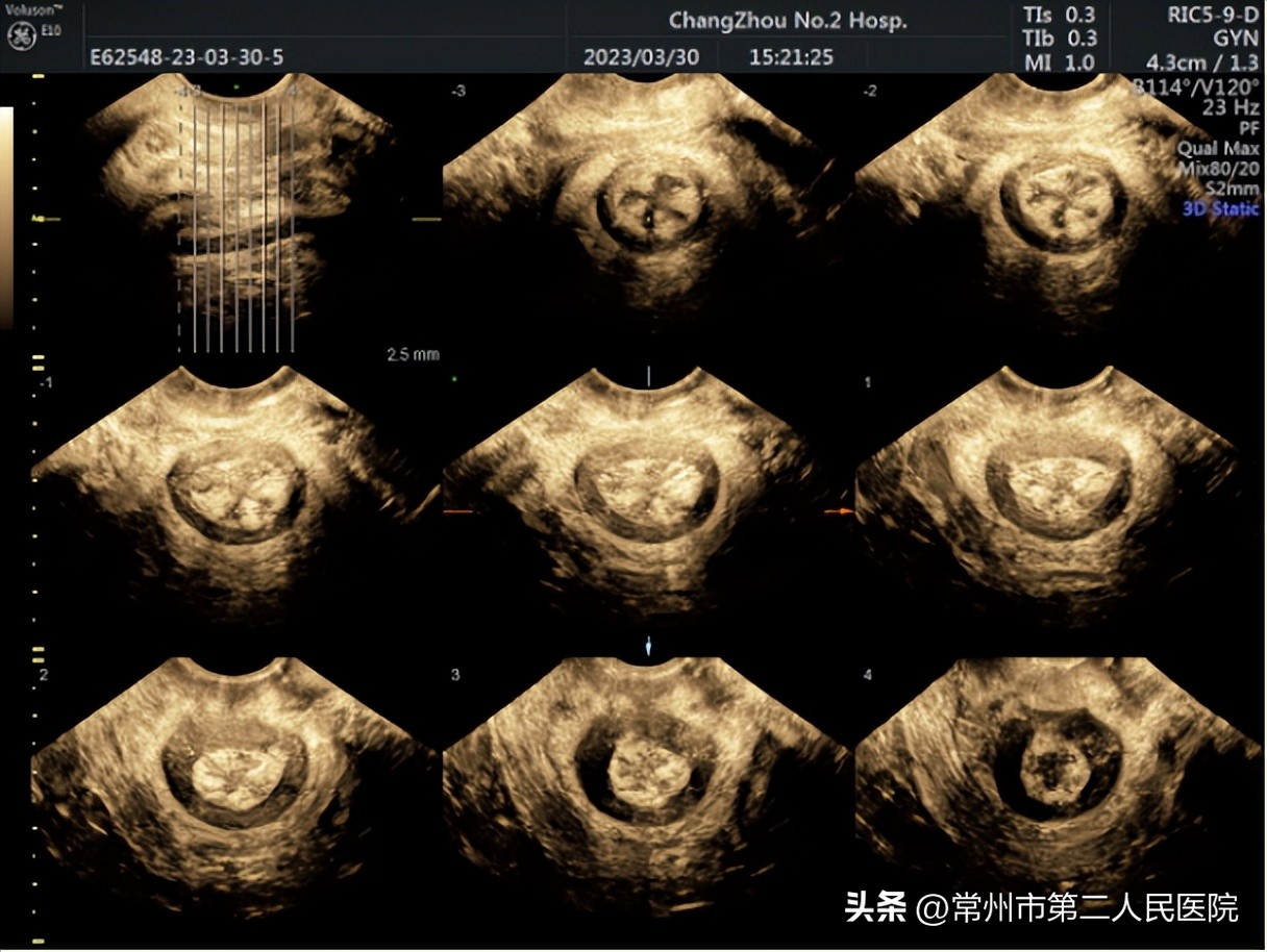 盆底超声帮您解决难言之隐,你的盆底肌还好吗