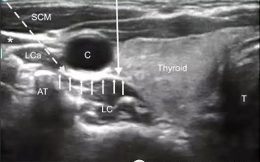 濮阳市人民医院：“看得见”的治疗-超声引导下星状神经节阻滞术