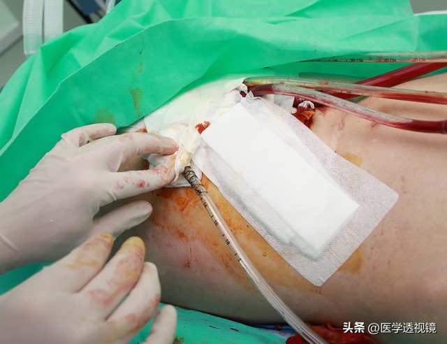 腹部手术后为啥总有下坠感,腹部手术后里面疼怎么回事