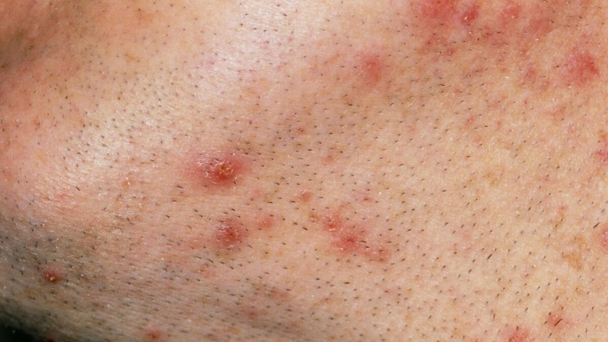 头皮上长痘痘是什么原因怎么处理,头皮突然长脓包痘怎么治