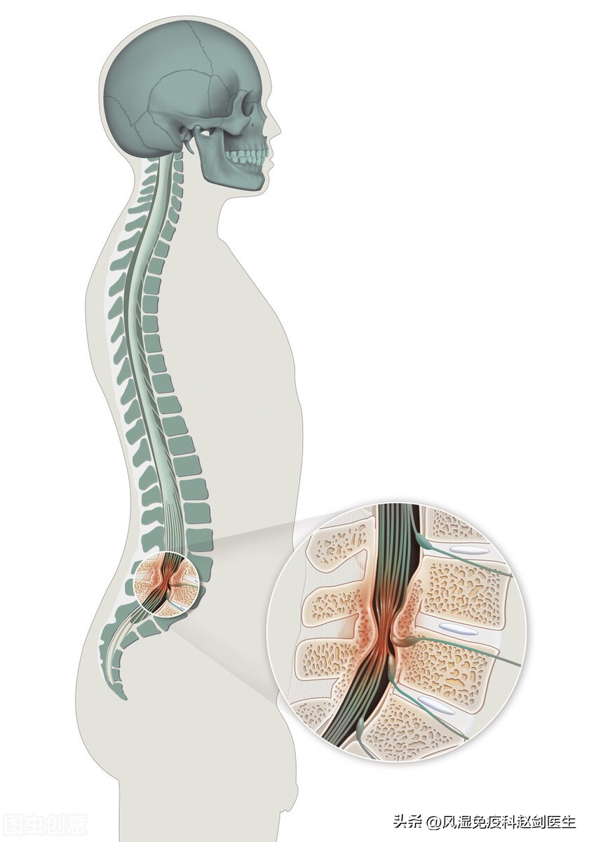 腰突马尾神经综合征发病率,坐骨神经跟马尾神经是一回事么