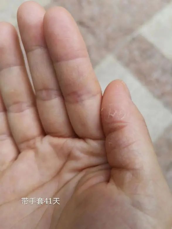 只需2步搞定宝宝湿疹,0-1岁祛湿疹的药