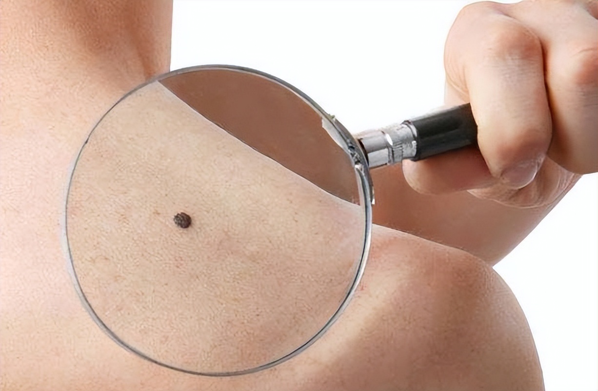 皮肤上的痣癌变是什么症状,出生就有的黑色痣会癌变吗