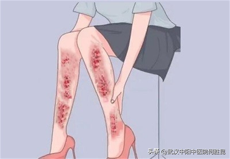 腿上发红斑皮肤干燥起一片一片的皮屑很痒