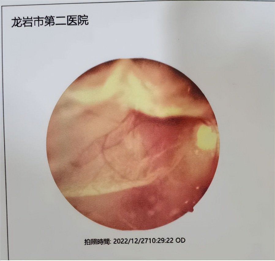 视网膜脱落找不到怎么办,视网膜脱落不能手术怎么办
