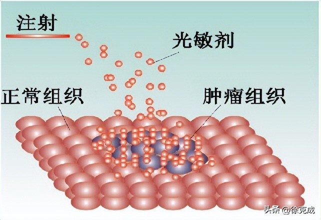 徐克成大讲堂,徐克成谈癌症克星