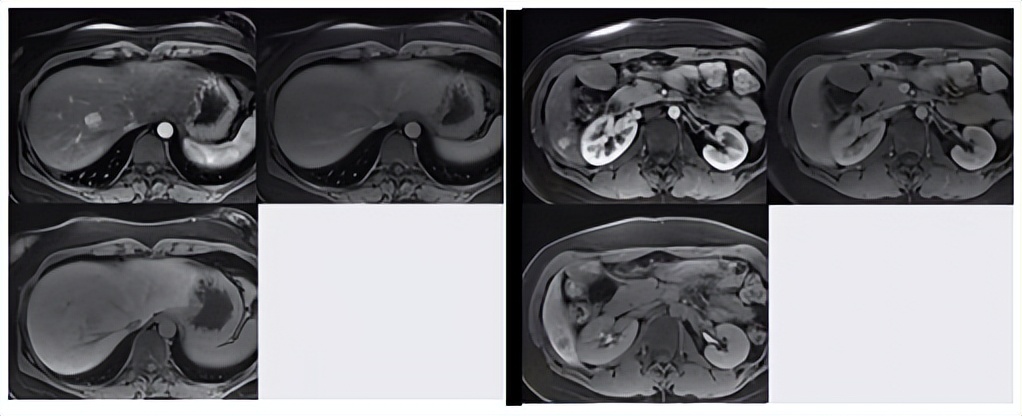 肝囊肿和肝占位影像学鉴别,杨永峰医生个人简历