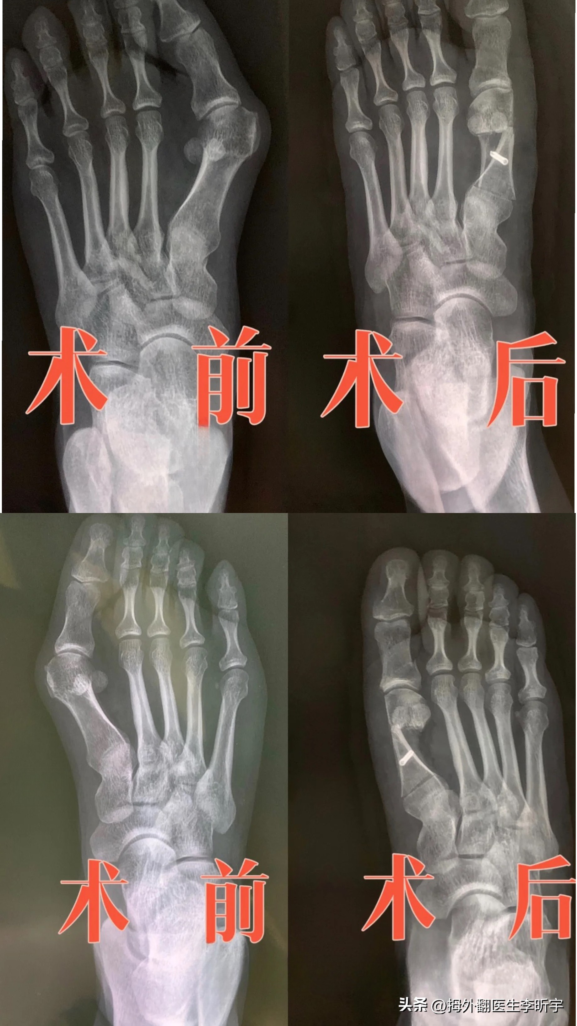 「案例分享」摆脱了多年的大脚骨，我现在是越看越喜欢！