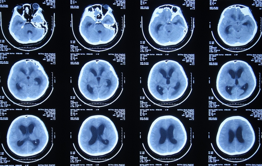 结核性脑积水能治愈吗,儿童结核脑膜炎脑积水