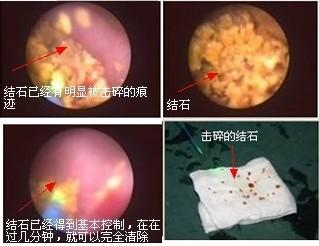 南昌大学二附院泌尿科主任,南昌一附院泌尿外科结石专家