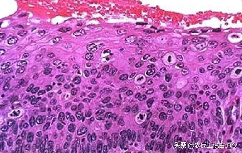 宫颈活检结果和锥切病理结果区别,宫颈活检结果报告减号