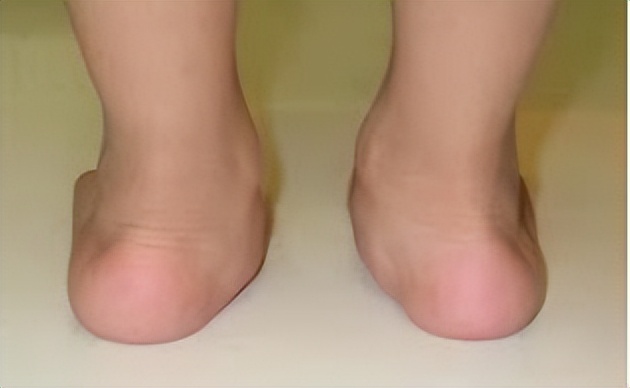 1岁宝宝不愿走路总是要爬怎么办,2岁宝宝一只脚扁平足怎么办