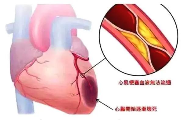 冠心病要警惕心肌梗死,冠心病怎么预防心肌梗死
