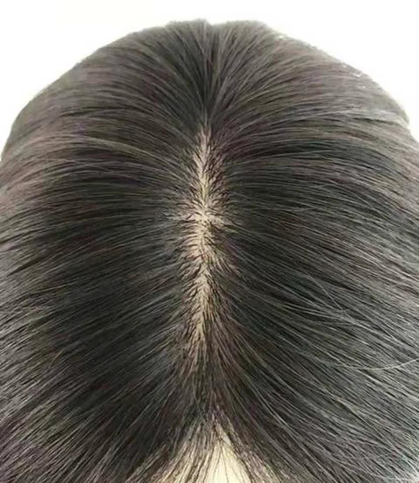 一个月内如何快速生发不变秃头,已经秃的地方怎么快速生发