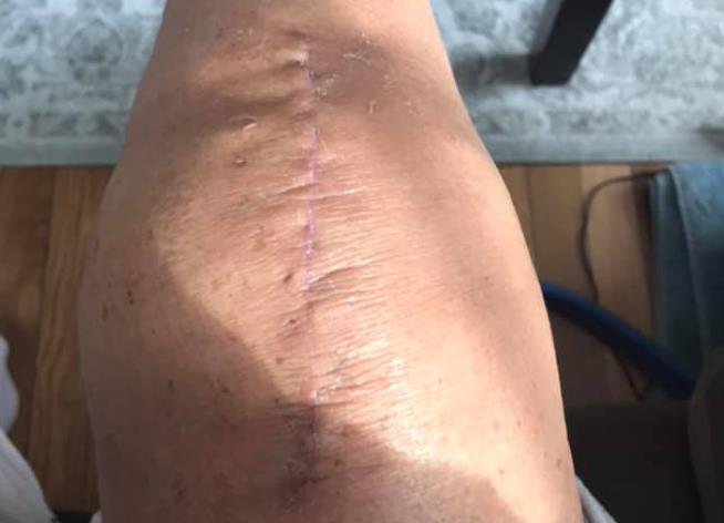 换了膝盖多长时间就不痛了,换了膝盖怎么康复