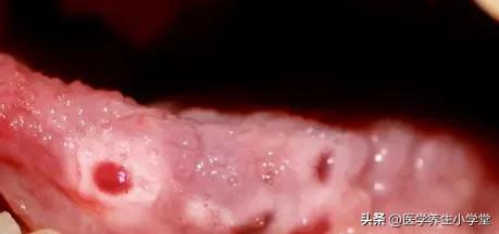 嘴巴长溃疡一般是什么原因,嘴巴经常长溃疡是什么原因引起的