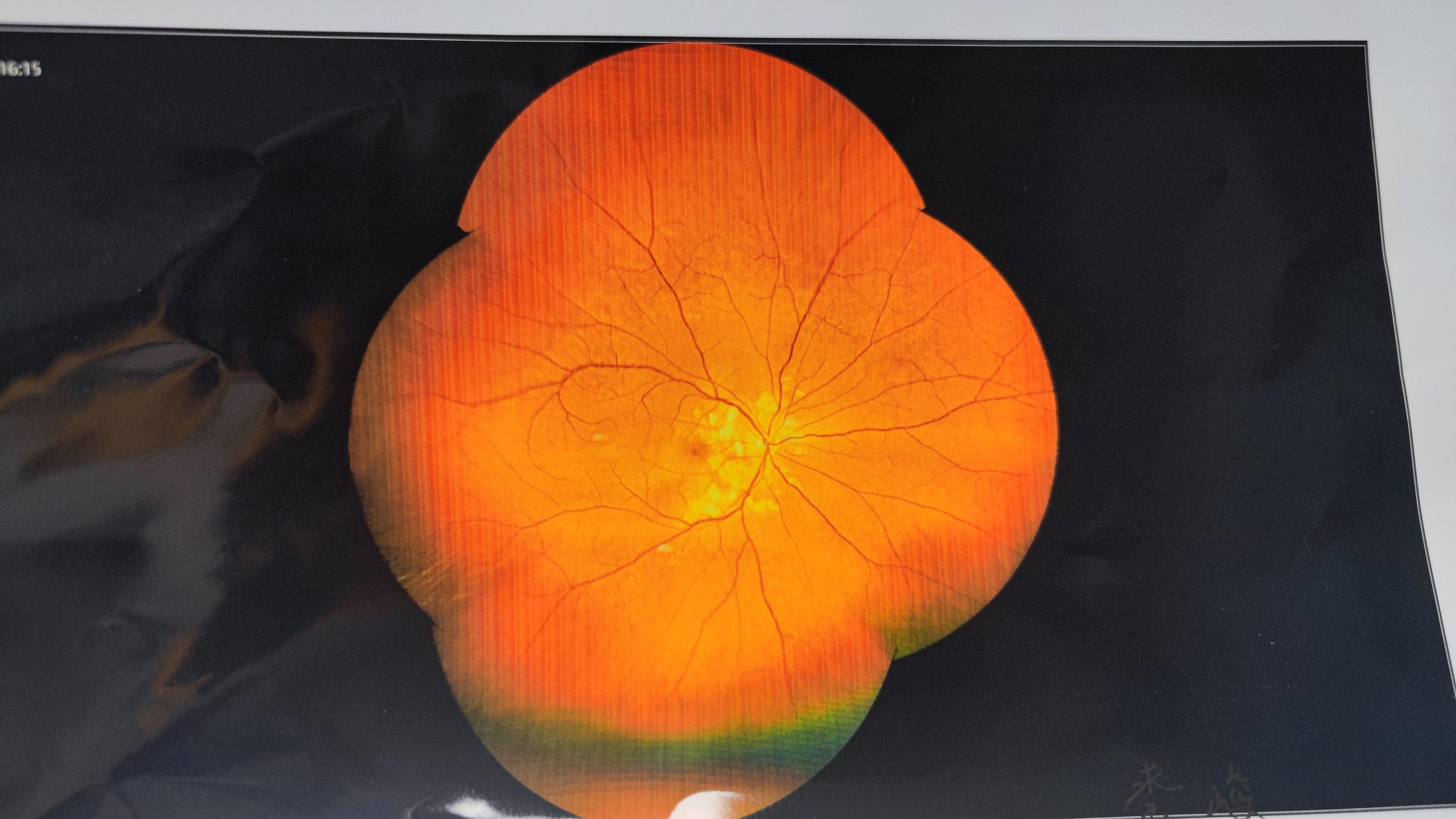 嘴巴摔伤会出脓吗,脸摔了一下眼睛失明了