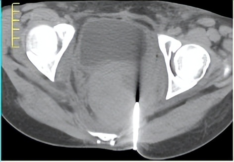 外阴鳞癌放疗后复发还能活多久,宫颈鳞癌化疗后病灶没缩小