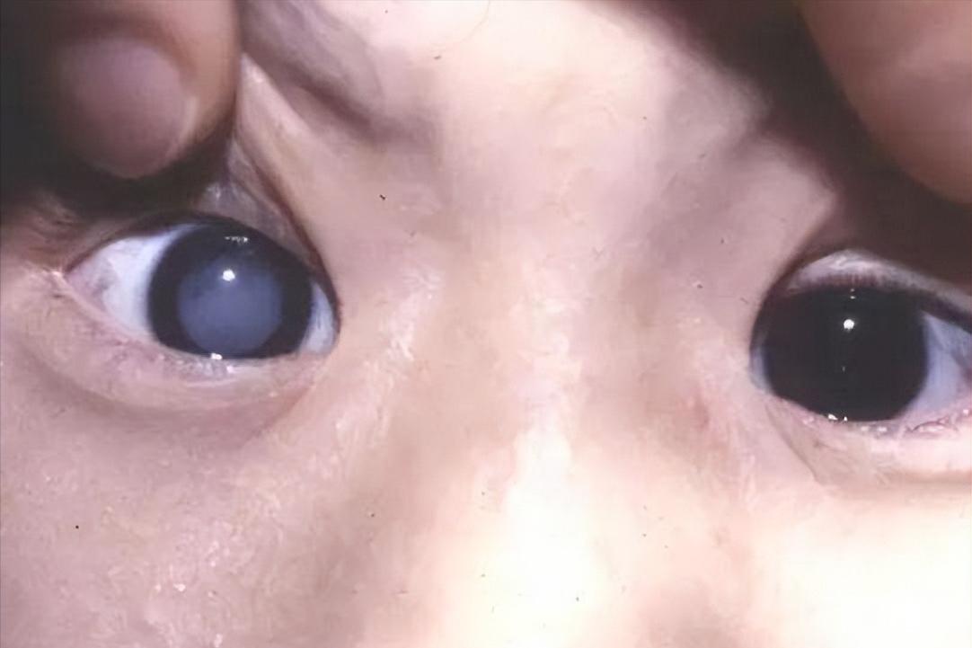 小孩看不懂视力表怎么查视力,婴儿视力不正常的表现