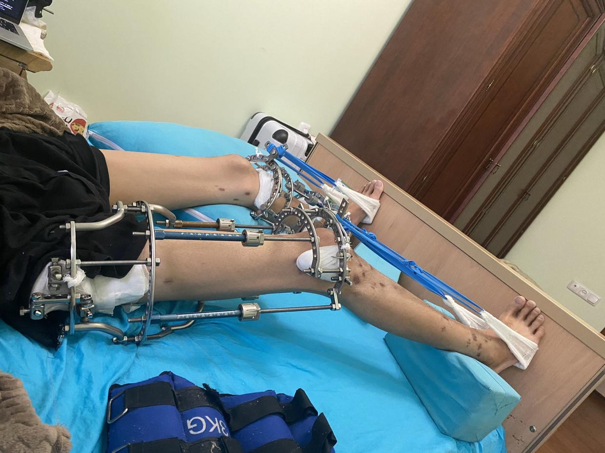 日本1米5小哥砸1600万疯狂整容增高！断骨惨烈过程吓傻网友