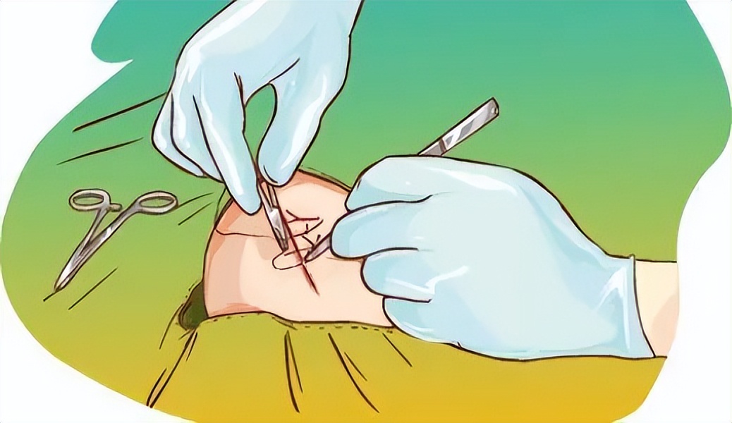 鄂尔多斯市中医医院急诊科,急诊科美容缝合后护理