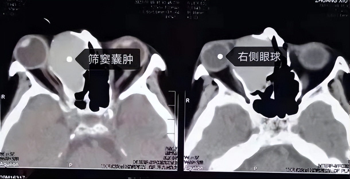 鼻窦浆液性囊肿症状,小石头学习