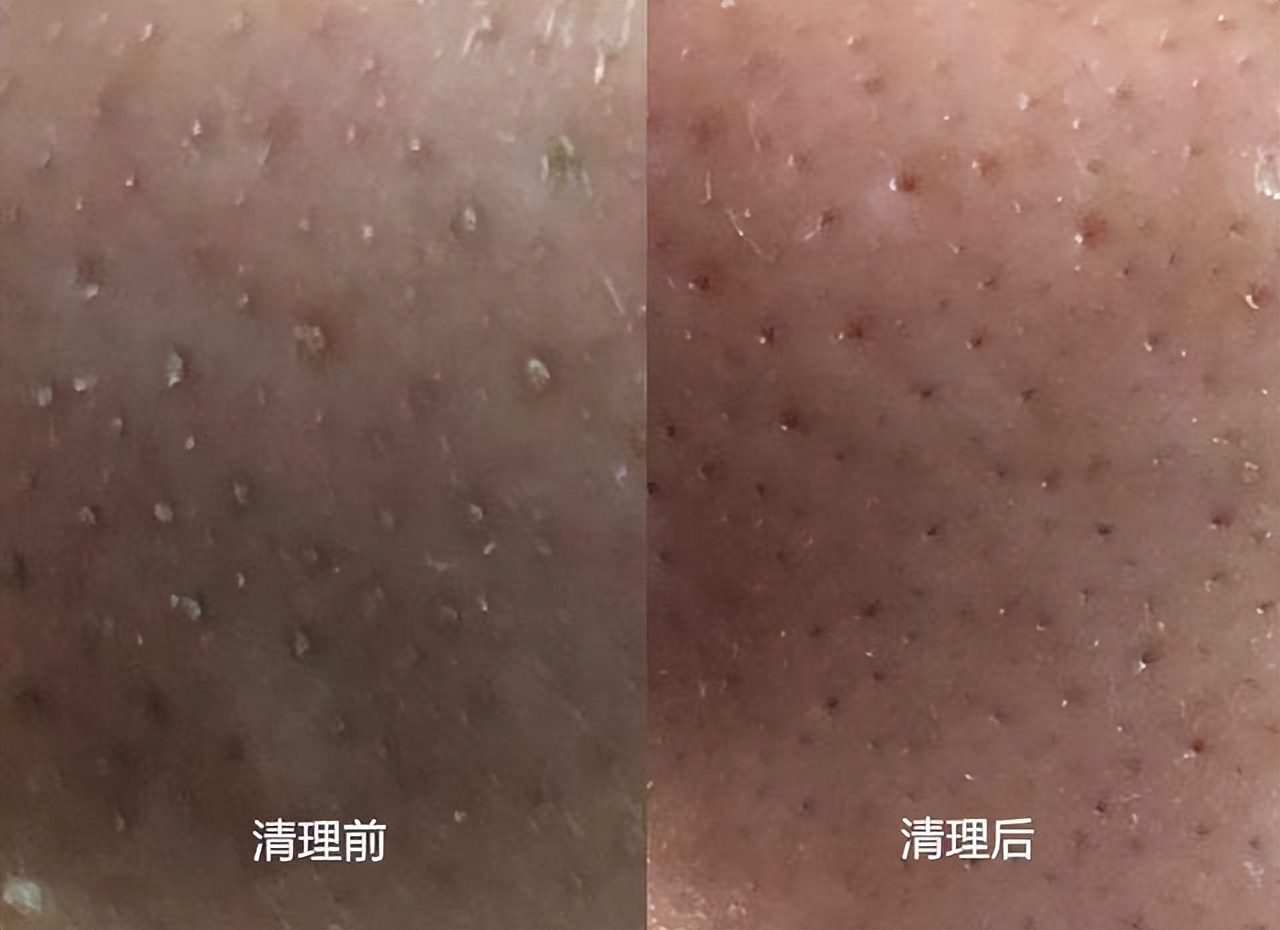 眉心鼻翼和下巴长粉刺为什么,鼻头上起粉刺什么原因引起的图片