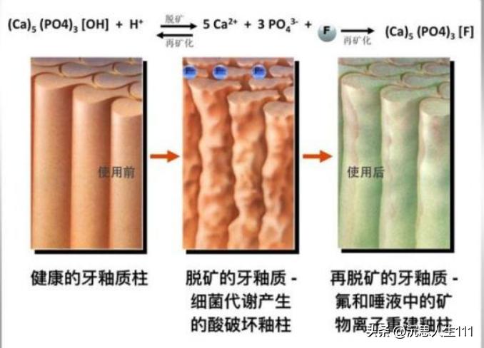 龋齿的形成原因和过程动画,龋齿发生机制的图片