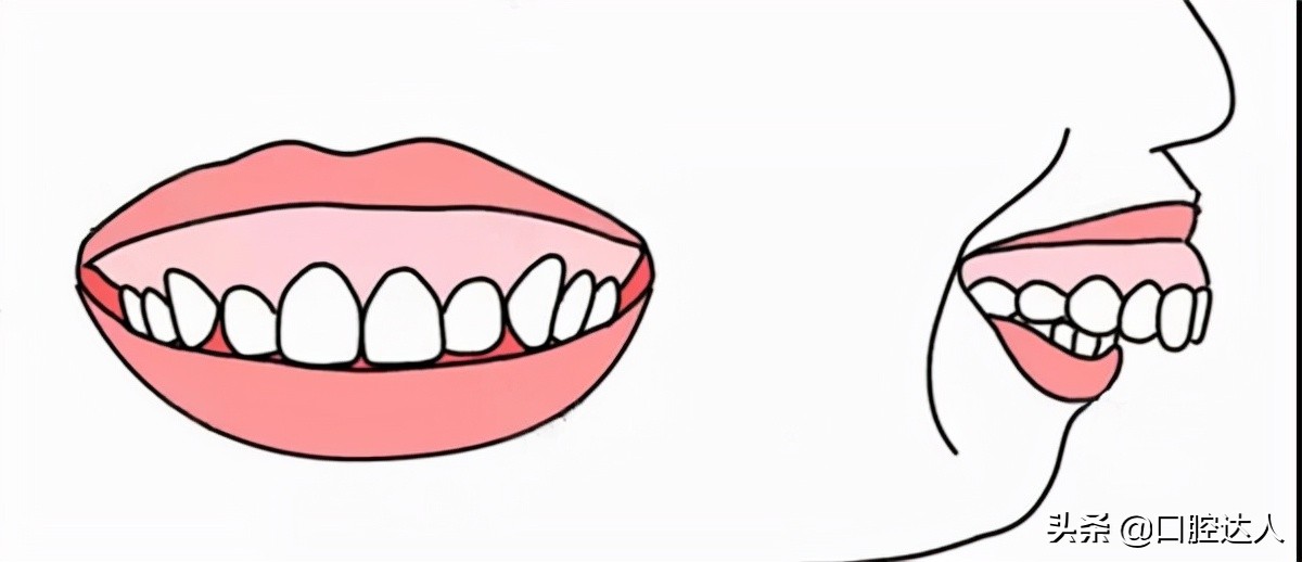 打骨钉改善露龈笑多久能看到效果,露龈笑是天生的吗