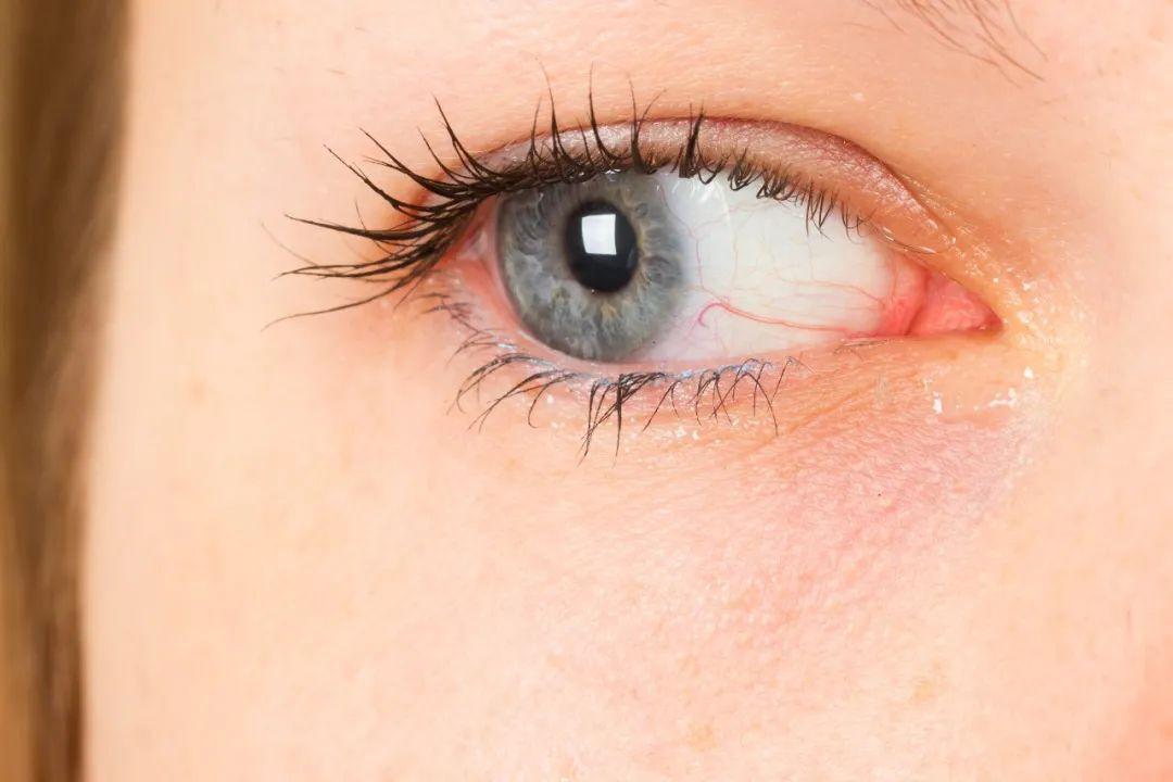 中山大学眼科中心斜视矫正手术,眼科斜视矫正手术步骤