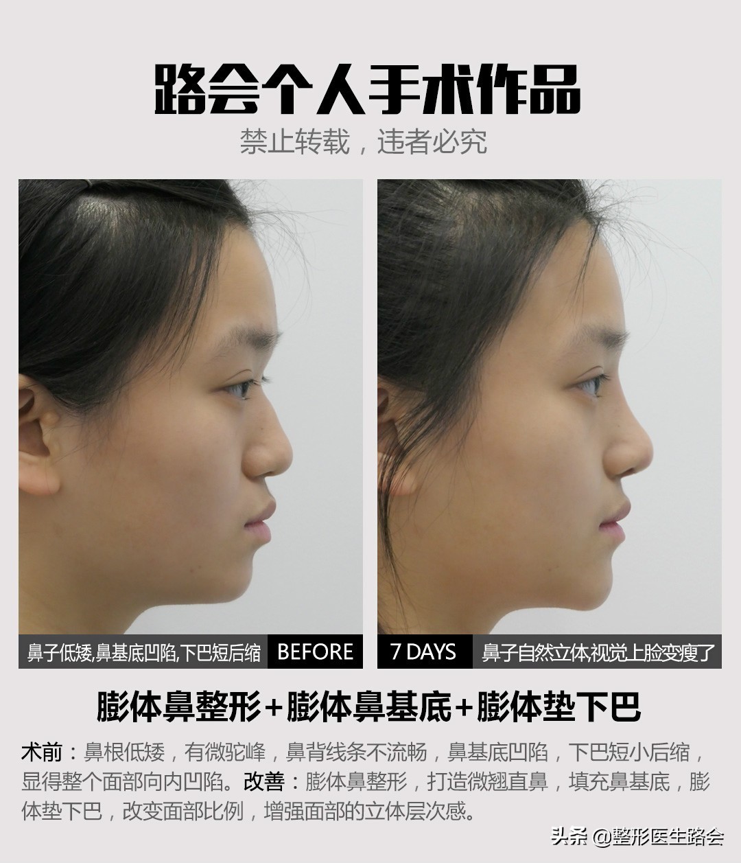 三甲医院鼻整形医生,鼻子整形医生科普类视频