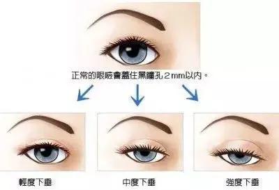 怎么判断眼皮松弛严不严重,眼皮松弛有皱纹怎么办