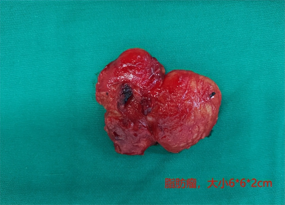 神经外科切除头皮脂肪瘤,脂肪瘤外科门诊手术